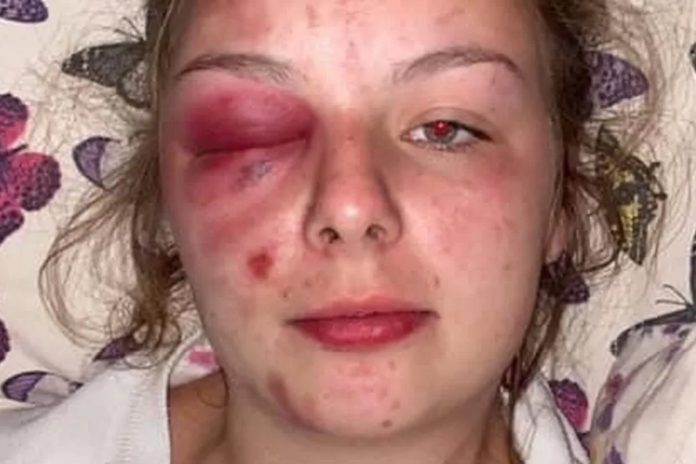 22-latka sama zadała sobie te obrażenia młotkiem, by oskarżyć mężczyzn o gwałt i pobicie Źródło: Facebook